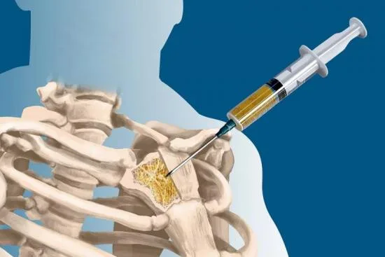 Ablation d'une Tumeur de la Moelle Osseuse 0 Ablation d'une Tumeur de la Moelle Osseuse