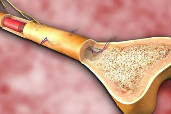 Ablation d'une Tumeur de la Moelle Osseuse 1 Ablation d'une Tumeur de la Moelle Osseuse