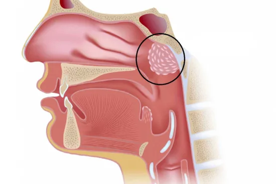 Adenoid removal in Turkey at a reasonable price 2026 Adenoid removal in Turkey at a reasonable price 2026