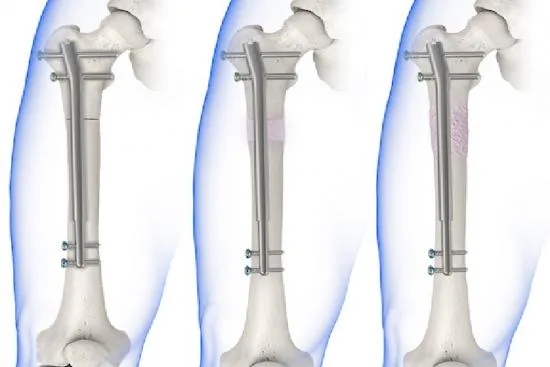 Bone lengthening: Personalized recovery 2026 Bone lengthening: Personalized recovery 2026