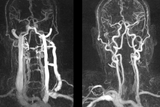 Cerebral angiography in Turkey Cerebral angiography in Turkey