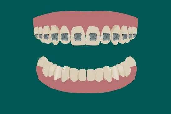 Tipos de aparatos dentales en Turquía Tipos de aparatos dentales en Turquía