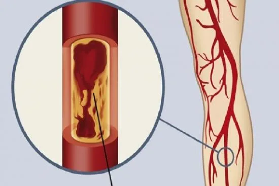 Arteriopathy obliterans treatment