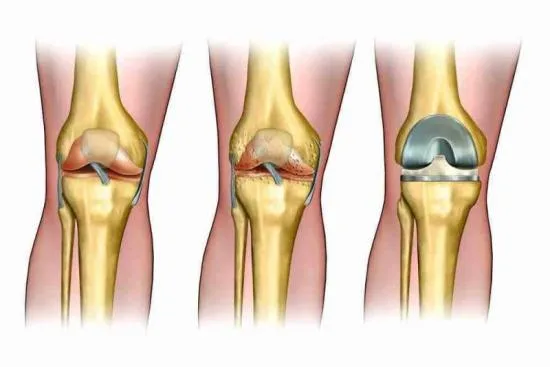 Traitement arthrose 1 Traitement arthrose