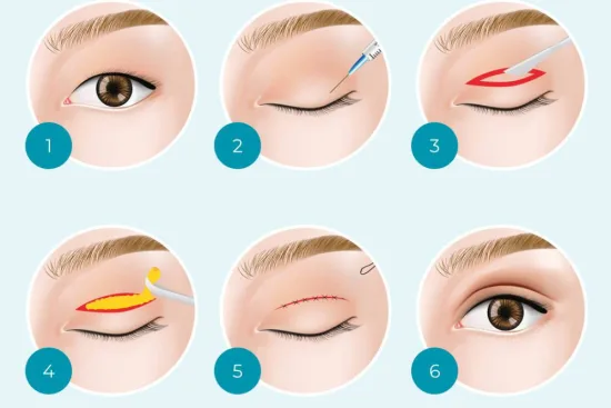 Blepharoplasty process (upper and lower) 2026 Blepharoplasty process (upper and lower) 2026