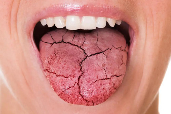 Treatment of tongue cancer