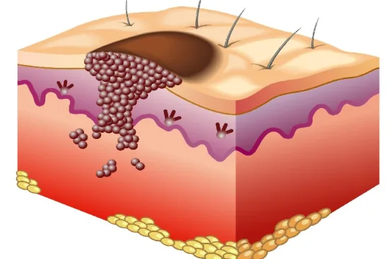 Skin cancer treatment
