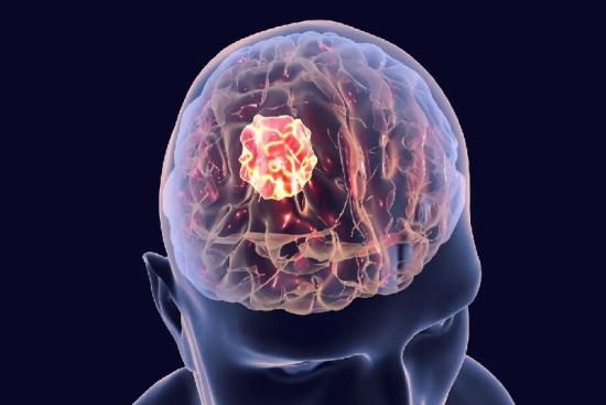 Brain cancer treatment