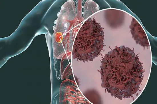 Cáncer de pulmón: Causas y factores de riesgo 2026 Cáncer de pulmón: Causas y factores de riesgo 2026
