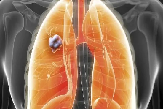 Diagnóstico del cáncer de pulmón en Estambul 2026 Diagnóstico del cáncer de pulmón en Estambul 2026