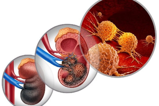 Kidney cancer treatment Turkey Kidney cancer treatment Turkey