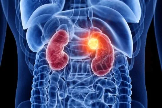 Gastric Cancer Surgery in Turkey Gastric Cancer Surgery in Turkey