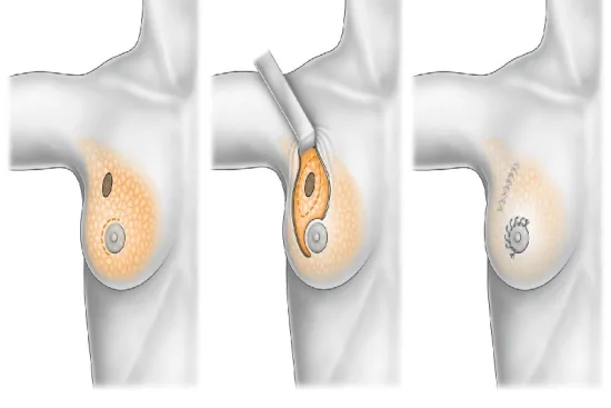 Breast cancer treatment