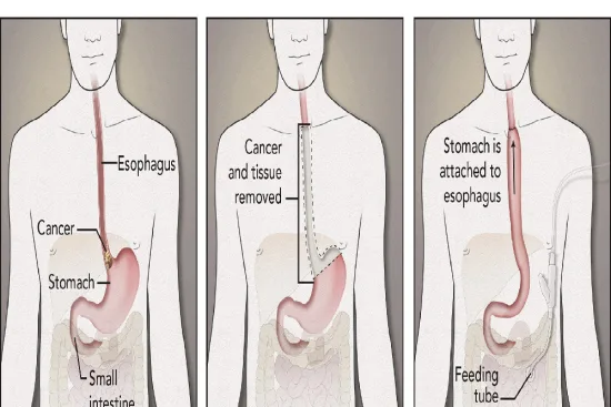 Chirurgie du cancer de l'œsophage en Turquie 2026 Chirurgie du cancer de l'œsophage en Turquie 2026