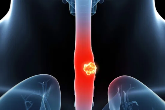Causes du cancer œsophagien 2026 Causes du cancer œsophagien 2026