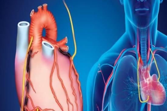 Coronary Artery Bypass Grafting