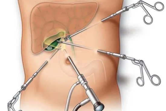 Cholécystectomie : Traitement de la cholécystite en Turquie Cholécystectomie : Traitement de la cholécystite en Turquie