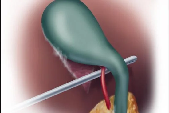 Causes de la cholécystite Causes de la cholécystite