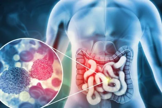 What is colorectal surgery? 2026 What is colorectal surgery? 2026