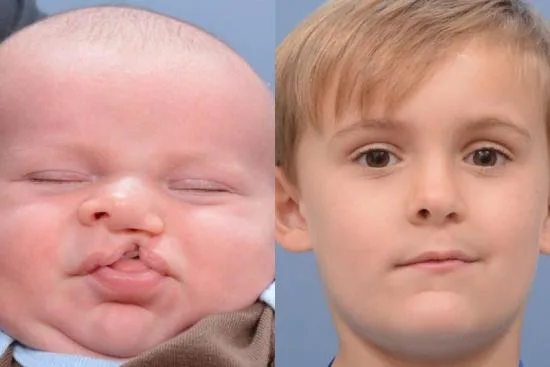 ¿Qué es la deformidad nasal del labio leporino? 2026 ¿Qué es la deformidad nasal del labio leporino? 2026