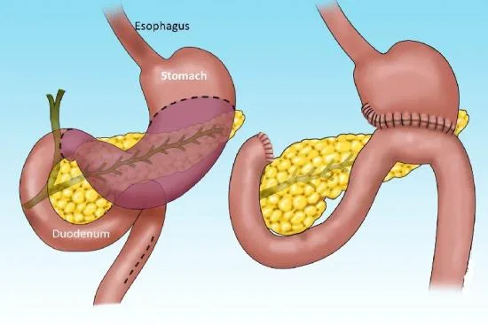 Warning signs of stomach cancer Warning signs of stomach cancer