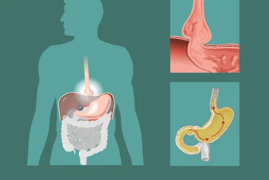 Causas de la hernia de hiato Causas de la hernia de hiato