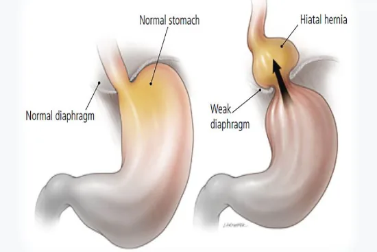 Diagnóstico de la hernia de hiato Diagnóstico de la hernia de hiato