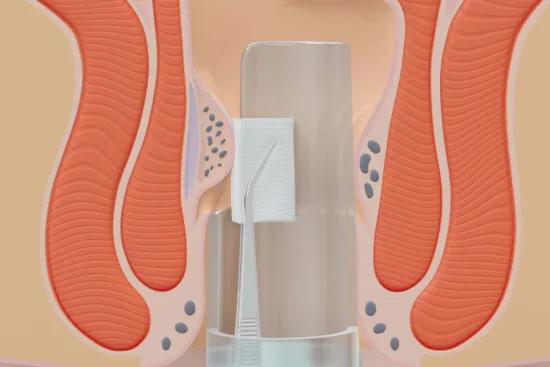 hemorrhoids surgery hemorrhoids surgery