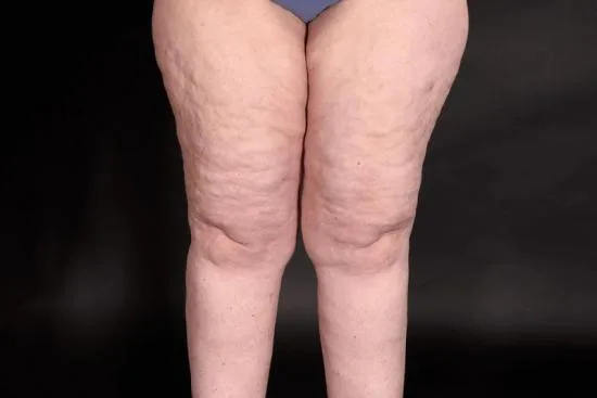 Why lipedema surgery might be right for you 2026 Why lipedema surgery might be right for you 2026