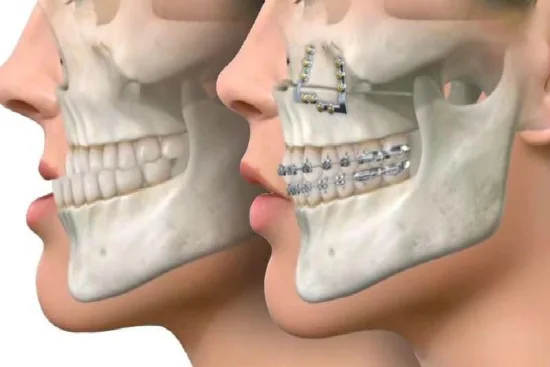 Orthognathic surgery process in Turkey 2026 Orthognathic surgery process in Turkey 2026