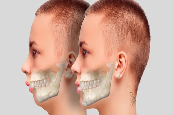 Preoperative phase for jaw surgery 2026 Preoperative phase for jaw surgery 2026