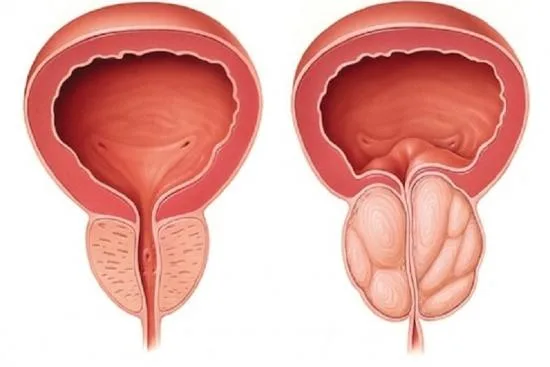 Types of prostate surgery 2026 Types of prostate surgery 2026