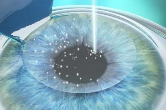 When is refractive surgery a good option? 2026 When is refractive surgery a good option? 2026