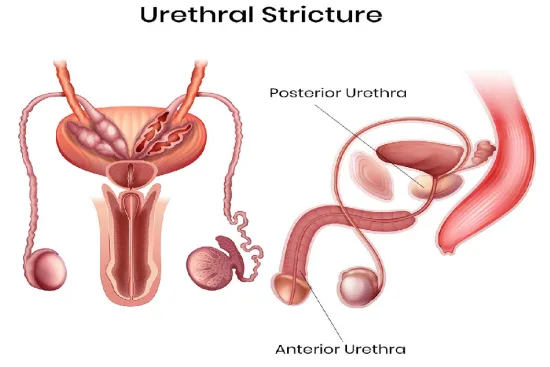 Diagnosis of urethral stricture in Turkey 2026 Diagnosis of urethral stricture in Turkey 2026