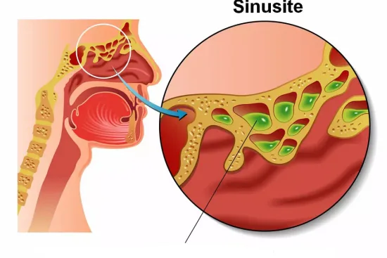 Diagnostic de la sinusite en Turquie 2026 Diagnostic de la sinusite en Turquie 2026
