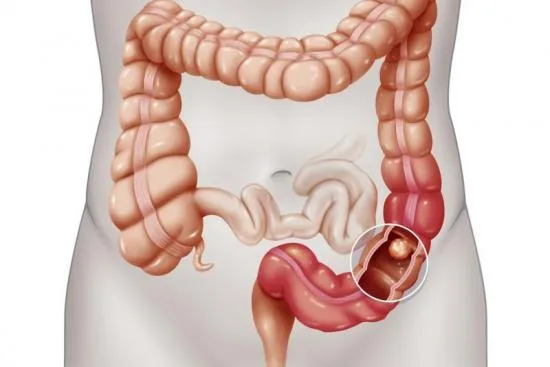 What is a colectomy? 2026 What is a colectomy? 2026