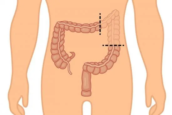 When is a colectomy indicated? 2026 When is a colectomy indicated? 2026