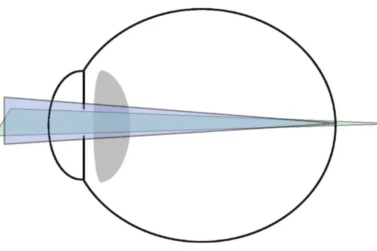 Correction of astigmatism in Turkey Correction of astigmatism in Turkey