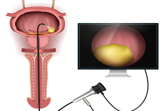 Cystoscopy Turkey