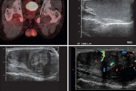Testicular ultrasound Testicular ultrasound