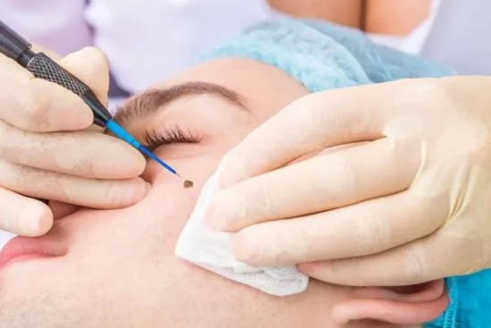 Is it effective to remove a mole at home? 2026 Is it effective to remove a mole at home? 2026