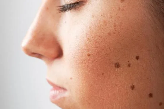 When should I see a dermatologist about a mole? 2026 When should I see a dermatologist about a mole? 2026