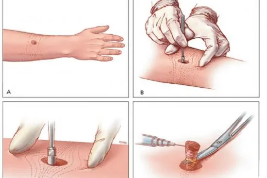 Mole removal in Turkey: laser or scalpel 2026 Mole removal in Turkey: laser or scalpel 2026
