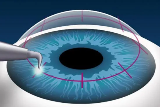 Different types of corneal transplant procedures in Istanbul, Turkey 2026 Different types of corneal transplant procedures in Istanbul, Turkey 2026