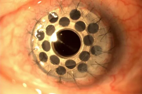 Corneal diagnosis: In which cases? 2026 Corneal diagnosis: In which cases? 2026