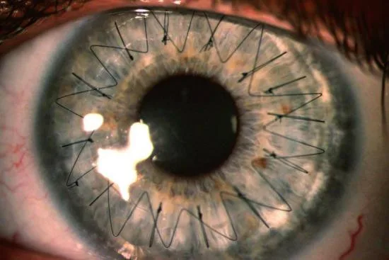 What is a cornea transplant? 2026 What is a cornea transplant? 2026