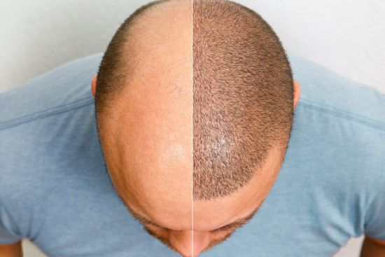 Hair transplant without shaving Hair transplant without shaving