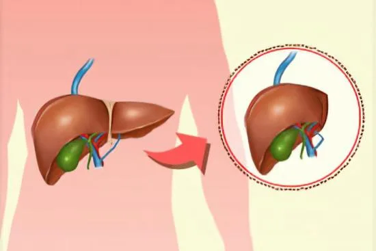 La transplantation hépatique en Turquie La transplantation hépatique en Turquie