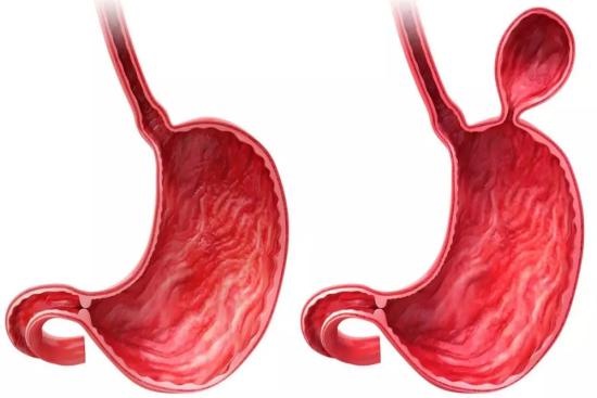 Chirurgie de l'hernie hiatale Turquie