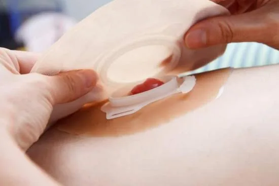 What is an ileostomy? 2026 What is an ileostomy? 2026